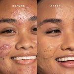 Tower 28's Everyday Base-ics Set includes SunnyDays™ SPF 30 provides light-medium buildable coverage and UV protection, as well as Swipe Serum Concealer covers dark circles, redness, and blemishes with a skin-like natural finish. Here shows our model's before and after using Swipe Concealer. [Shared]