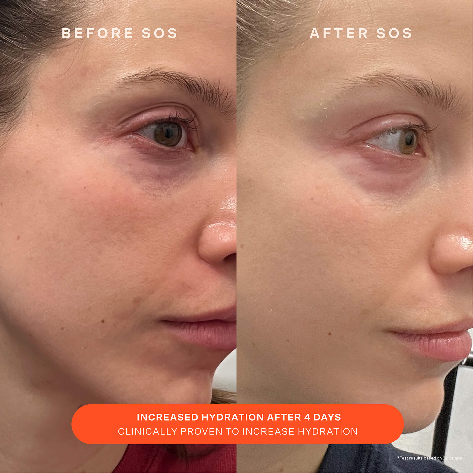 A comparison before and after the use of Tower 28 Beauty SOS Recovery Cream. "Increased hydration after 4 days. Clinically proven to increase hydration." [Shared]
