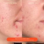 A comparison before and after the use of Tower 28 Beauty SOS Recovery Cream. "Skin texture after 3 days. Clinically proven to improve skin texture." [Shared]